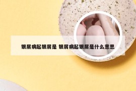 银屑病起银屑是 银屑病起银屑是什么意思