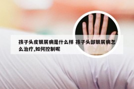 孩子头皮银屑病是什么样 孩子头部银屑病怎么治疗,如何控制呢