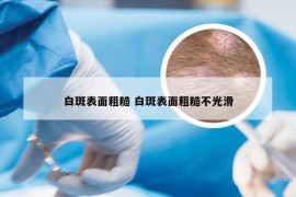 白斑表面粗糙 白斑表面粗糙不光滑