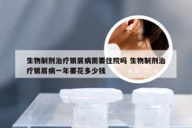 生物制剂治疗银屑病需要住院吗 生物制剂治疗银屑病一年要花多少钱