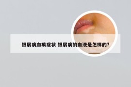 银屑病血痕症状 银屑病的血液是怎样的?