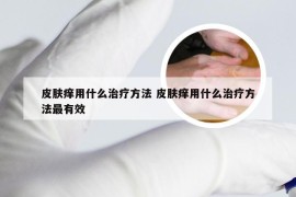 皮肤痒用什么治疗方法 皮肤痒用什么治疗方法最有效