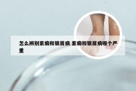 怎么辨别紫癜和银屑病 紫癜和银屑病哪个严重