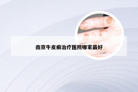 南京牛皮癣治疗医院哪家最好