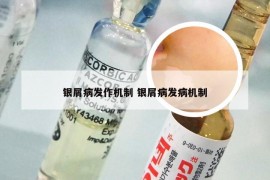 银屑病发作机制 银屑病发病机制