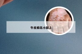 牛皮癣出小腿上