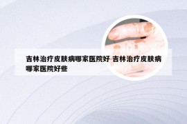 吉林治疗皮肤病哪家医院好 吉林治疗皮肤病哪家医院好些