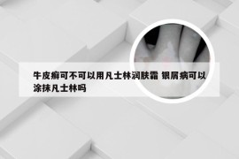 牛皮癣可不可以用凡士林润肤霜 银屑病可以涂抹凡士林吗