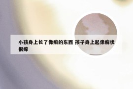 小孩身上长了像癣的东西 孩子身上起像癣状很痒