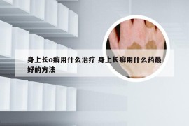 身上长o癣用什么治疗 身上长癣用什么药最好的方法