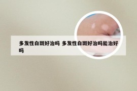 多发性白斑好治吗 多发性白斑好治吗能治好吗