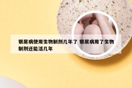 银屑病使用生物制剂几年了 银屑病用了生物制剂还能活几年