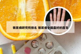 银屑病研究院排名 银屑病全国最好的医生