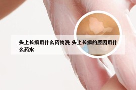 头上长癣用什么药物洗 头上长癣的原因用什么药水