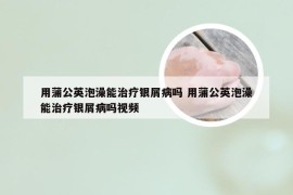 用蒲公英泡澡能治疗银屑病吗 用蒲公英泡澡能治疗银屑病吗视频