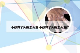 小孩得了头癣怎么治 小孩得了头癣怎么治疗