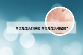 白斑是怎么行成的 白斑是怎么引起的?