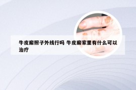 牛皮廨照子外线行吗 牛皮廨家里有什么可以治疗