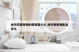 血热型银屑病的原因是什么 血热银屑病能治愈么