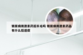 银屑病用激素药后长毛吗 银屑病用激素药品有什么后遗症