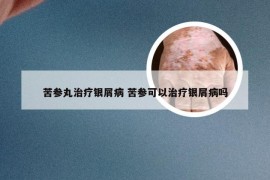 苦参丸治疗银屑病 苦参可以治疗银屑病吗