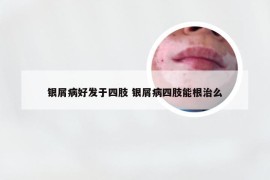 银屑病好发于四肢 银屑病四肢能根治么