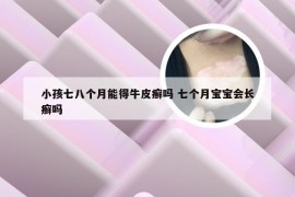 小孩七八个月能得牛皮癣吗 七个月宝宝会长癣吗