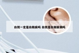 白斑一定是白殿疯吗 白斑是白颠疯病吗