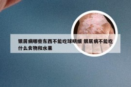 银屑病哪些东西不能吃球明细 银屑病不能吃什么食物和水果