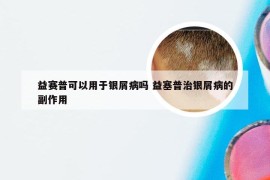 益赛普可以用于银屑病吗 益塞普治银屑病的副作用