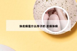 体皮癣是什么样子的 皮癣体癣