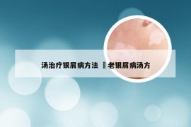 汤治疗银屑病方法 禤老银屑病汤方