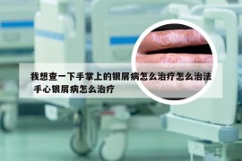 我想查一下手掌上的银屑病怎么治疗怎么治法 手心银屑病怎么治疗