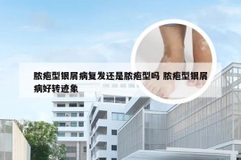 脓疱型银屑病复发还是脓疱型吗 脓疱型银屑病好转迹象