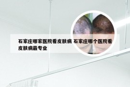 石家庄哪家医院看皮肤病 石家庄哪个医院看皮肤病最专业