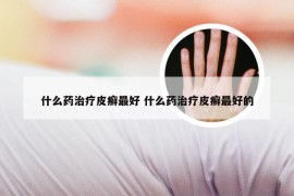 什么药治疗皮癣最好 什么药治疗皮癣最好的