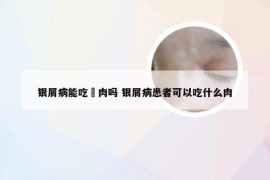 银屑病能吃馿肉吗 银屑病患者可以吃什么肉