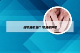 昌银屑病治疗 银屑病除根