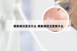 银屑病注意忌什么 银屑病该注意些什么