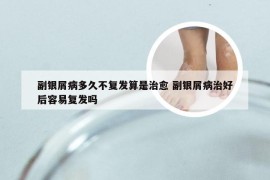 副银屑病多久不复发算是治愈 副银屑病治好后容易复发吗