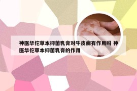 神医华佗草本抑菌乳膏对牛皮癣有作用吗 神医华佗草本抑菌乳膏的作用