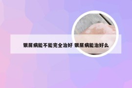 银屑病能不能完全治好 银屑病能治好么