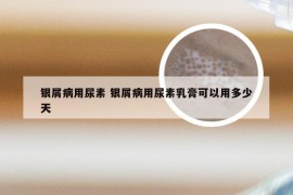 银屑病用尿素 银屑病用尿素乳膏可以用多少天