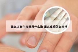 睾丸上有牛皮癣用什么治 睾丸皮癣怎么治疗