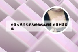 身体皮肤很多地方起癣怎么回事 身体到处长藓