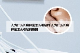 人为什么长癣藓是怎么引起的 人为什么长癣藓是怎么引起的原因