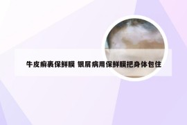 牛皮癣裹保鲜膜 银屑病用保鲜膜把身体包住