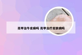 亮甲治牛皮癣吗 亮甲治疗皮肤病吗