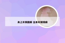 身上长铜圆癣 全身长铜钱癣