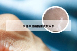 头部牛皮癣能用洗发水么